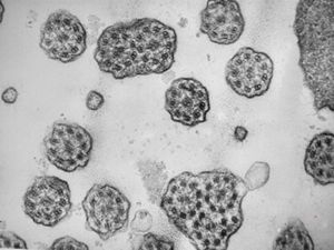 M,12y. | immotile cilia syndrome - nasal mucosa